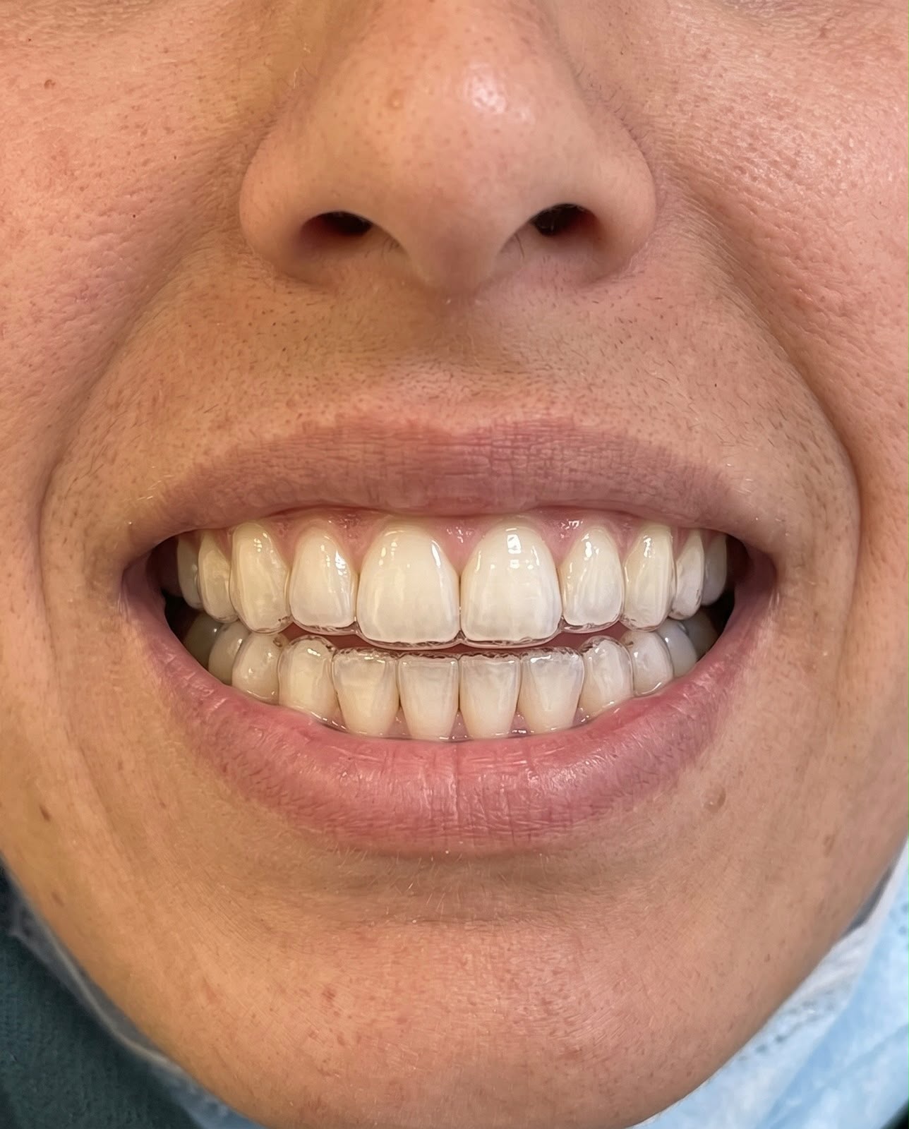 After braces treatment — aligned teeth