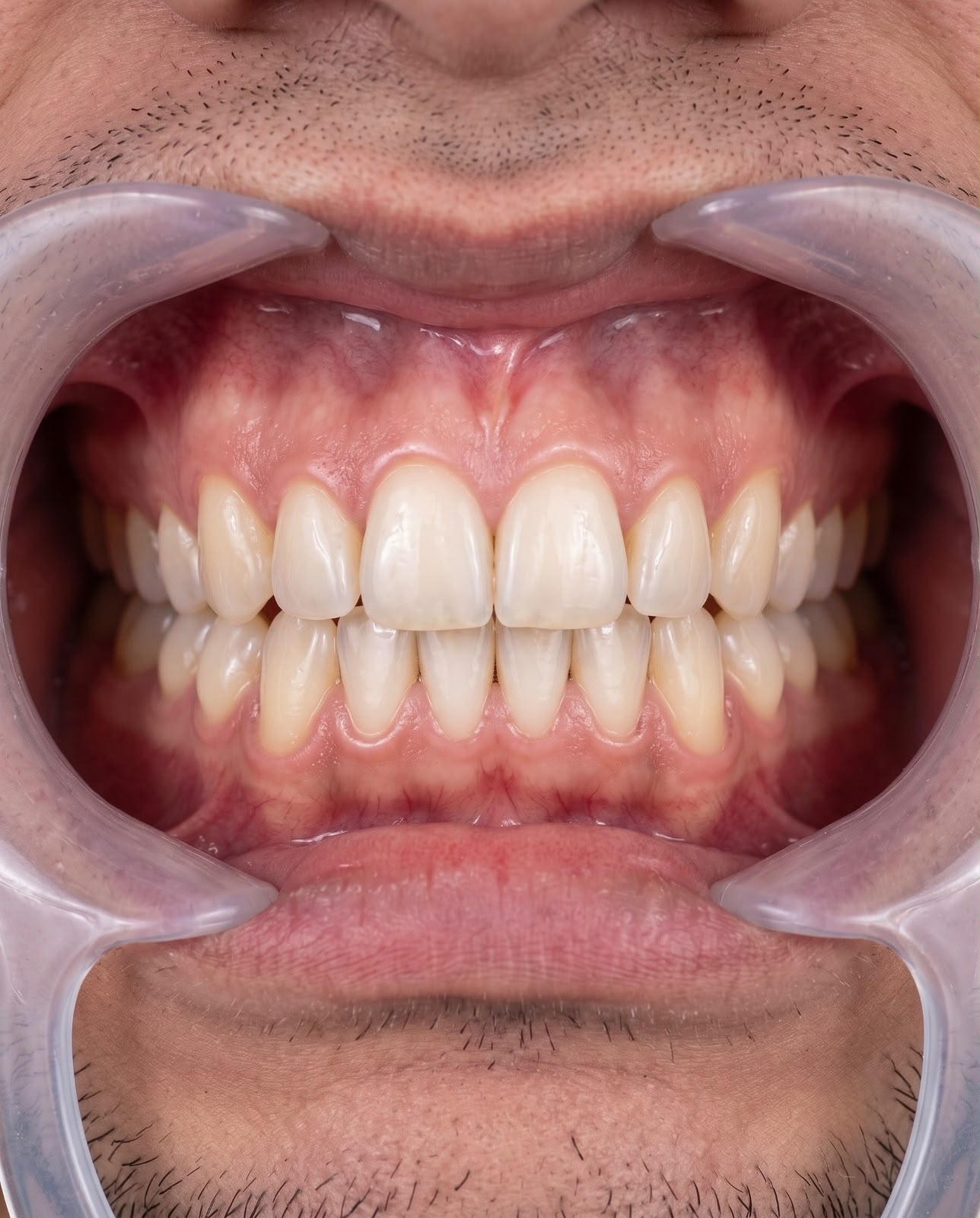 After clear aligner treatment — closed gaps
