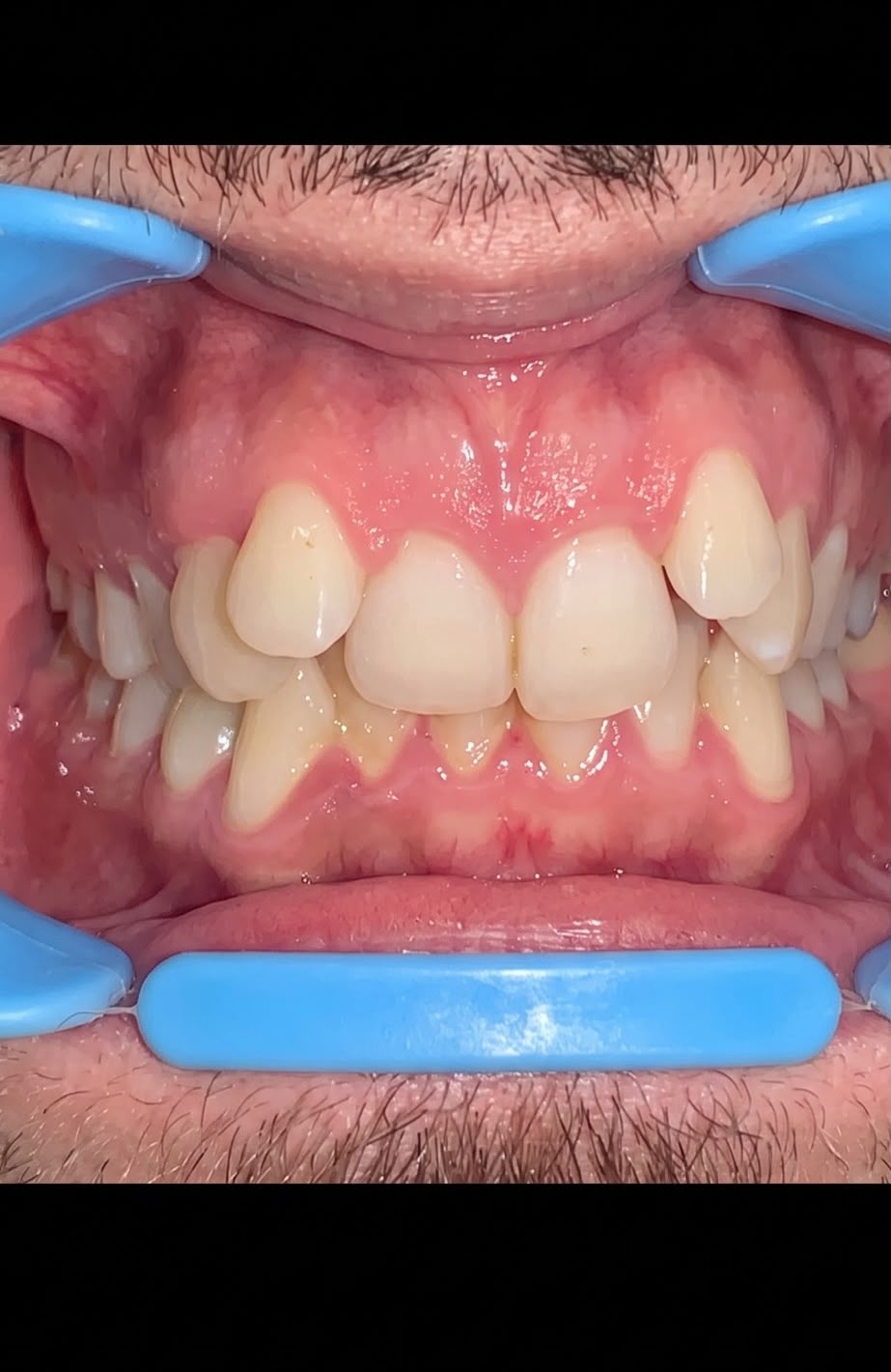 Before clear aligner treatment — gapped teeth