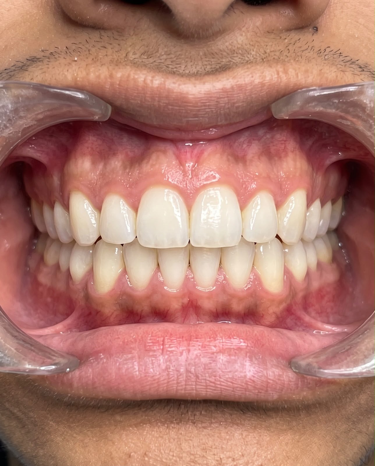 After bite correction treatment