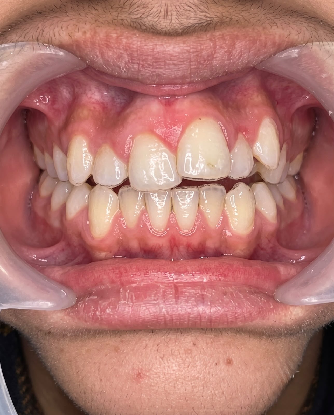 Before bite correction treatment