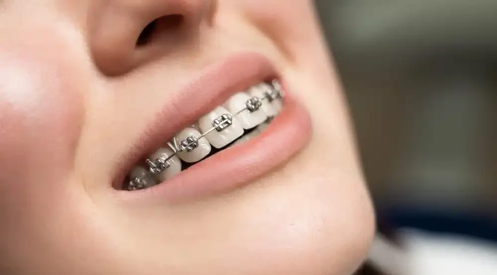 Orthodontic Braces Srinagar