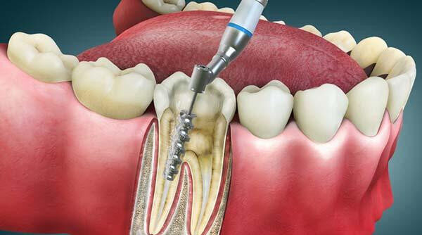 Root Canal Treatment in Srinagar